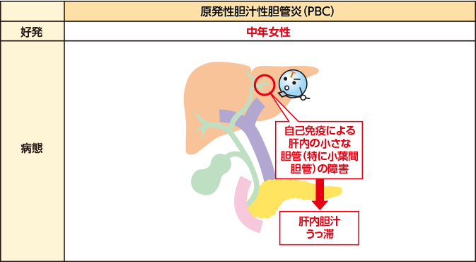 原発性胆汁性胆管炎（PBC）