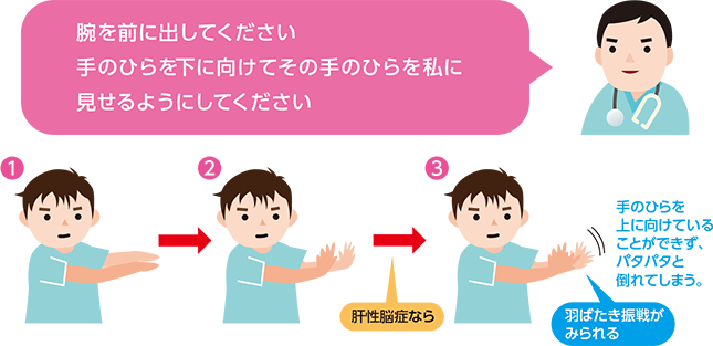 肝性脳症チェック 肝臓の病気にかかると出現する症状 よくわかる肝臓の病気 疾肝啓発