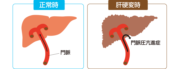 正常時・肝不全時