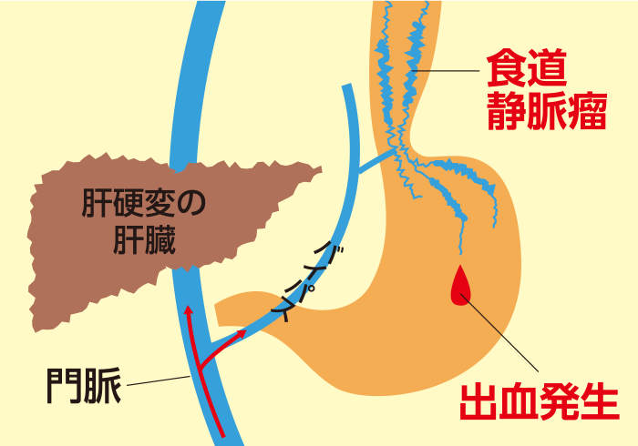 食道胃静脈瘤