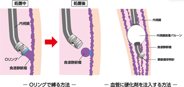 食道胃静脈瘤の治療