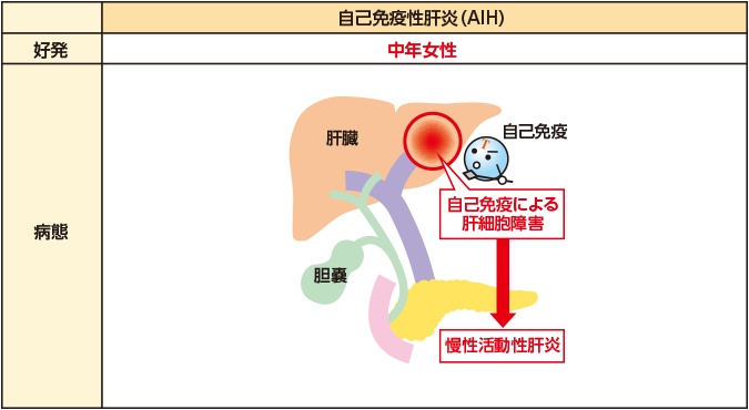 原発 性 胆汁 性 胆管 炎