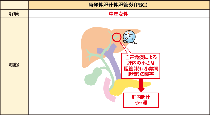 性 胆管 性 硬化 炎 原発 原発性硬化性胆管炎（PSC）