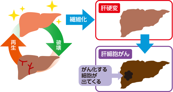 肝硬変 肝臓の病気 よくわかる肝臓の病気 疾肝啓発