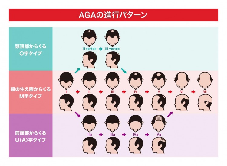 AGAの進行パターン