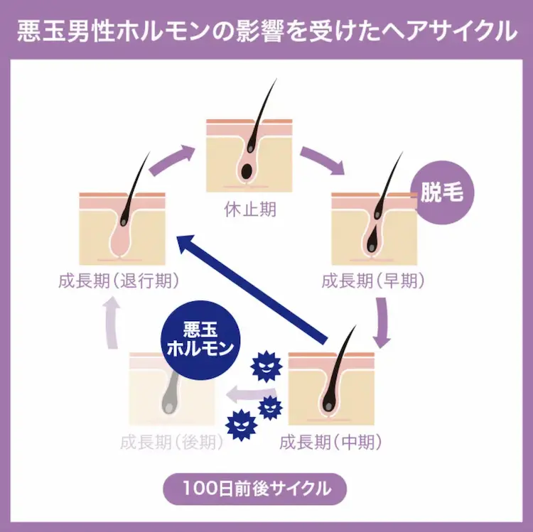 悪玉男性ホルモンの影響を受けたヘアサイクル