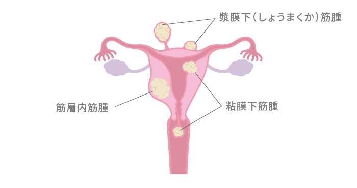 子宮筋腫の発生場所と種類