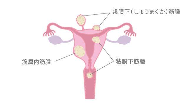 子宮筋腫の発生場所と種類