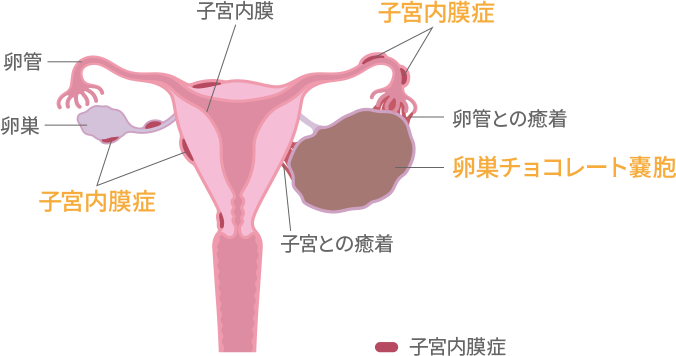 子宮内膜症について 早めに気づいて 女性に多い病気と症状 知っておきたい女性のカラダと健康のこと 女性のための健康ラボ Mint