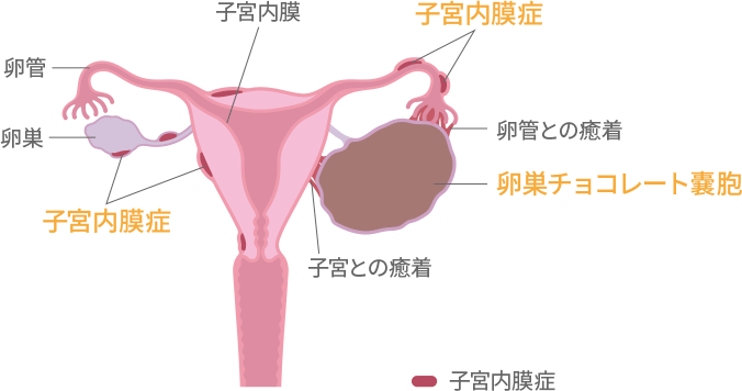 子宮内膜症における吐き気の原因は何ですか?