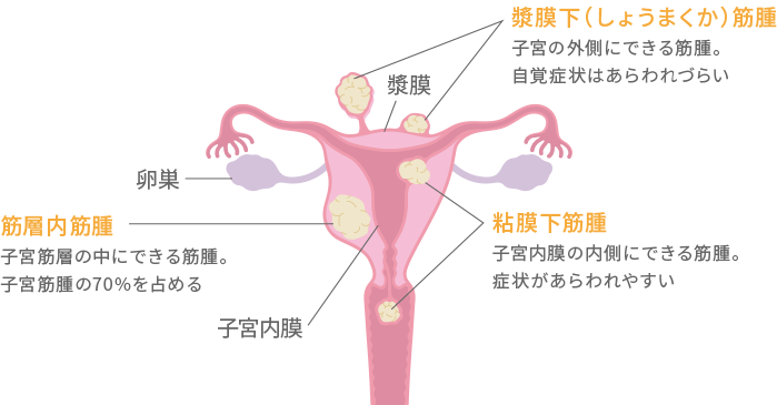 子宮筋腫の発生場所と種類
