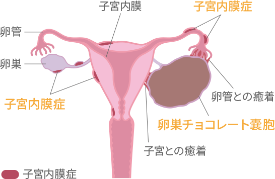 子宮内膜症について 早めに気づいて 女性に多い病気と症状 知っておきたい女性のカラダと健康のこと 女性のための健康ラボ Mint