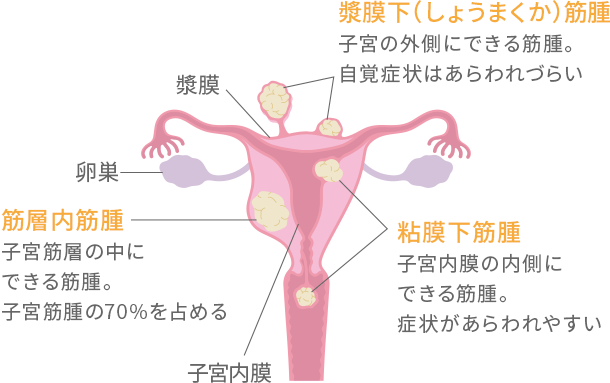 小さく する 筋腫 子宮