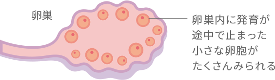 多嚢胞性卵巣症候群について 早めに気づいて 女性に多い病気と症状 知っておきたい女性のカラダと健康のこと 女性のための健康ラボ Mint